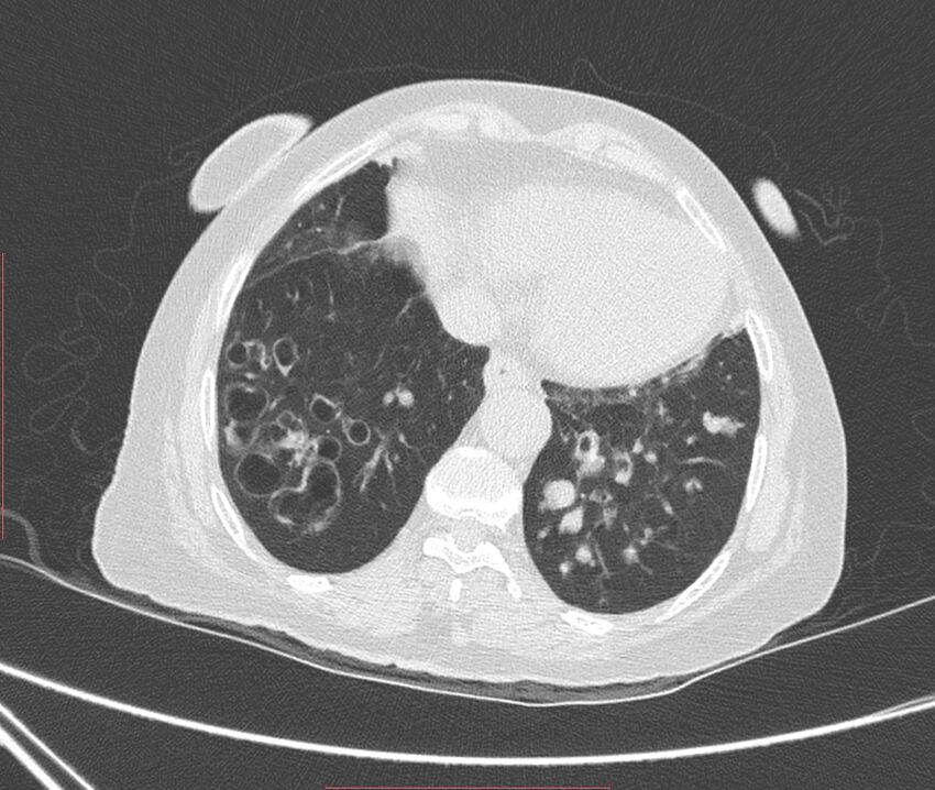 Bronchiectasis (Radiopaedia 72693-83293 Axial lung window 106).jpg