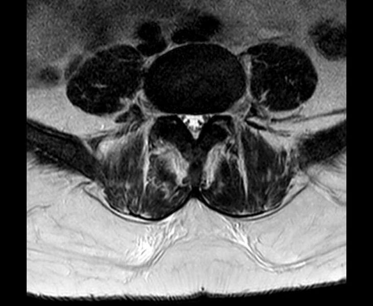 File:Brown tumors compressing the spinal cord (Radiopaedia 68442-78030 Axial T2 - lumbar 20).jpg