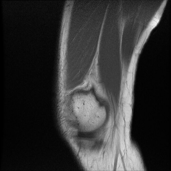 File:Bucket-handle meniscus tear (Radiopaedia 65700-74809 Sagittal T1 4).jpg