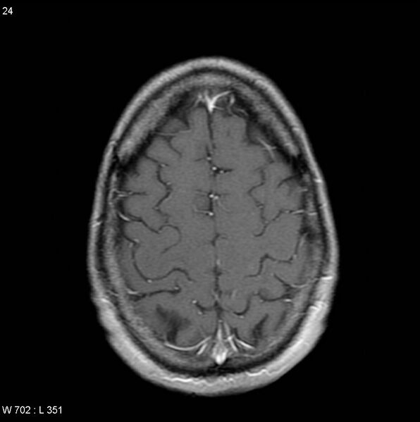 File:CMV ventriculitis and encephalitis (Radiopaedia 5416-7166 Axial T1 C+ 10).jpg