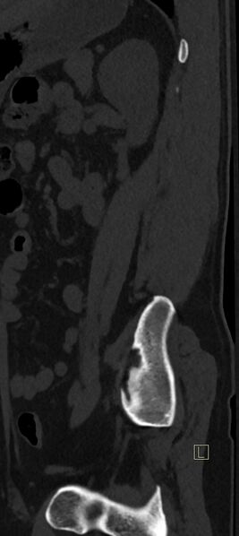 File:Calcaneal fractures with associated L2 burst fracture (Radiopaedia 71671-82493 Sagittal bone window 2).jpg