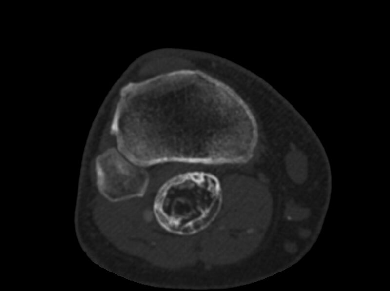 File:Calcified hematoma - popliteal fossa (Radiopaedia 63938-72763 C 63).jpg