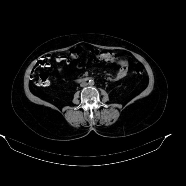 File:Calcified hydatid cyst (Radiopaedia 62000-70085 Axial non-contrast 59).jpg
