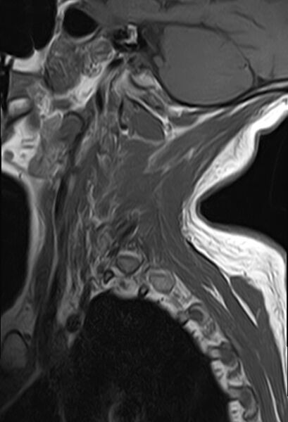 File:Calcified meningioma - cervical canal (Radiopaedia 70136-82468 Sagittal T1 2).jpg