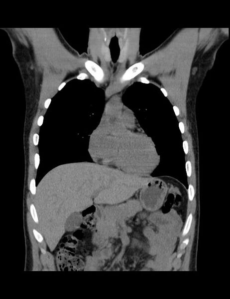 File:Calcifying pulmonary metastases (Radiopaedia 33359-34396 Coronal non-contrast 32).jpg