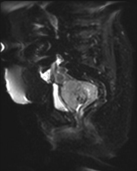 File:Cancer cervix - stage IIb (Radiopaedia 75411-86615 Sagittal DWI 10).jpg