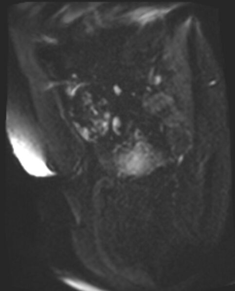 File:Cancer cervix - stage IIb (Radiopaedia 75411-86615 Sagittal DWI 43).jpg