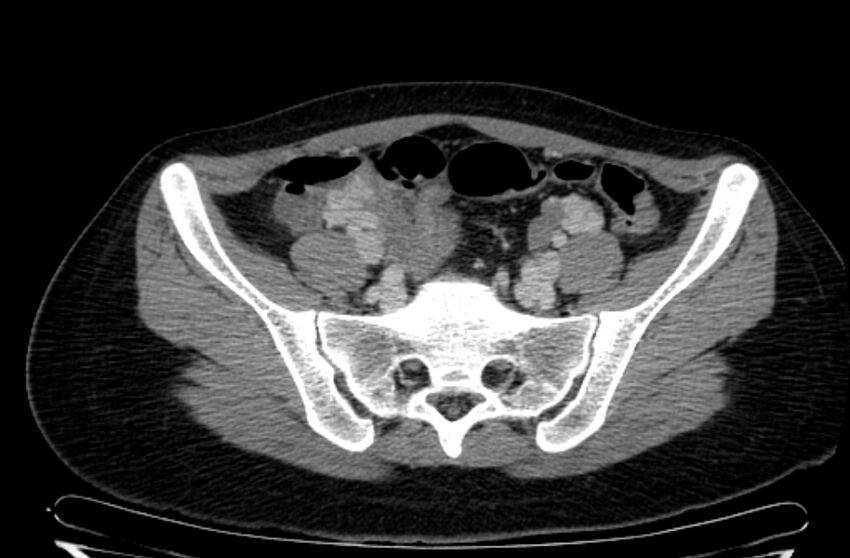Cannonball metastases - uterine choriocarcinoma (Radiopaedia 70137-80174 A 1).jpg
