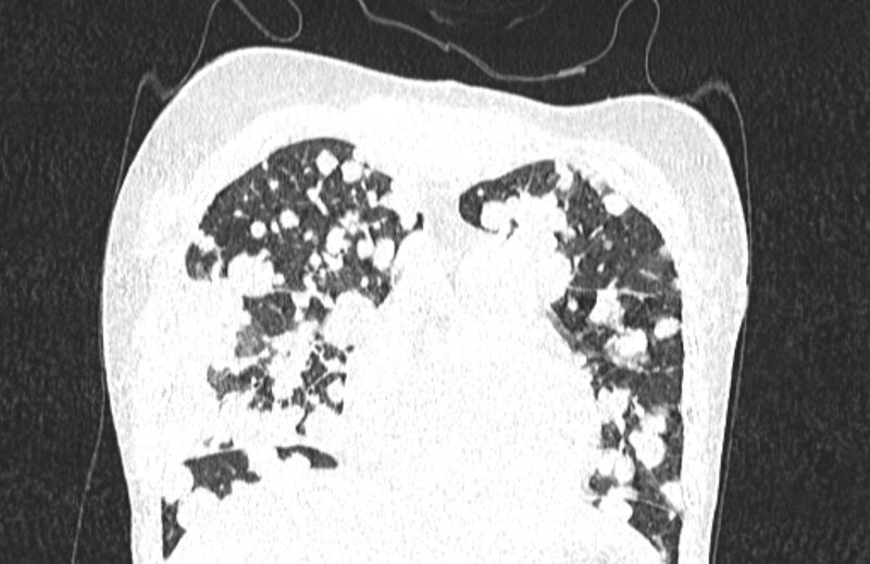 File:Cannonball metastases from breast cancer (Radiopaedia 91024-108569 Coronal lung window 41).jpg