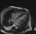 Cardiac amyloidosis (Radiopaedia 51404-57150 A 15).jpg