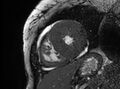 Cardiac amyloidosis (Radiopaedia 61600-69579 Short axis bSSFP 101).jpg