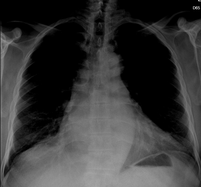 File:Cardiomegaly with left atrium enlargement (Radiopaedia 84873-100367 B 1).PNG