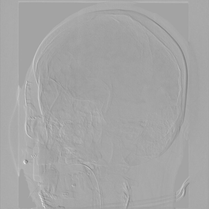 Caroticocavernous fistula - direct (Radiopaedia 61660-69666 Oblique Left ICA 42).jpg