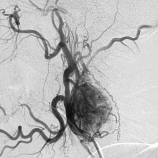 File:Carotid body tumor on angiography (Radiopaedia 4651-6729 B 1).jpg
