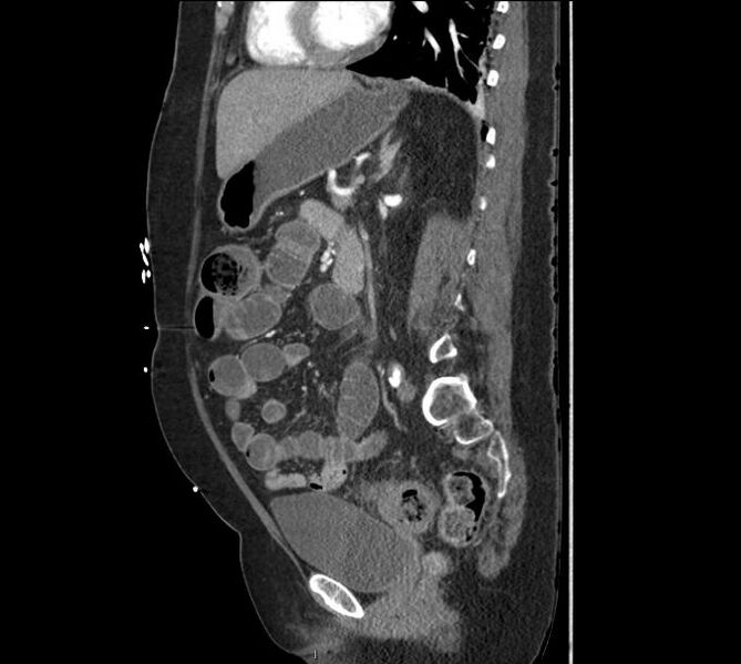 File:Celiac artery severe stenosis and dissection (Radiopaedia 44128-47842 A 15).jpg