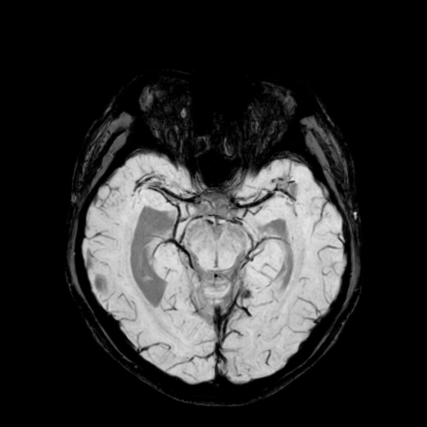 Central neurocytoma (Radiopaedia 79320-92380 Axial SWI 53).jpg