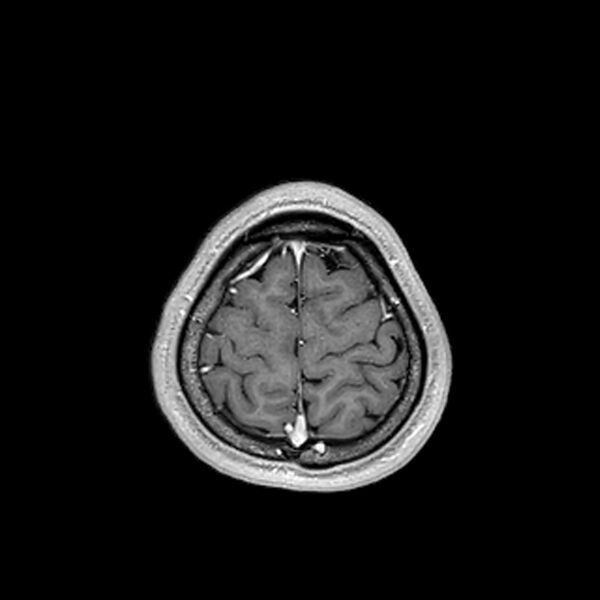File:Central neurocytoma (Radiopaedia 79320-92380 Axial T1 C+ 206).jpg