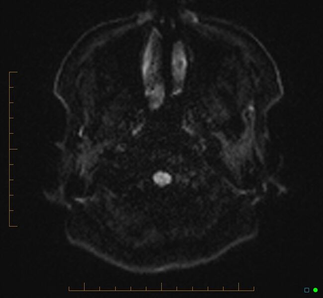 File:Cerebellar gangliocytoma (Radiopaedia 65377-74422 Axial DWI 1).jpg