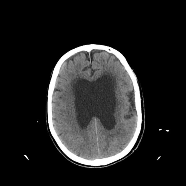 File:Cerebellar metastasis - lung tumor (Radiopaedia 69317-79145 Axial non-contrast 24).jpg