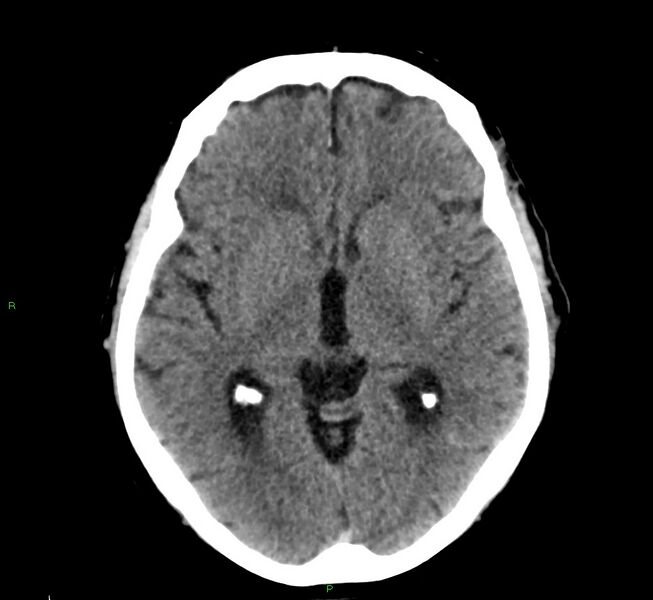 File:Cerebral amyloid angiopathy-associated lobar intracerebral hemorrhage (Radiopaedia 58376-65511 Axial non-contrast 32).jpg