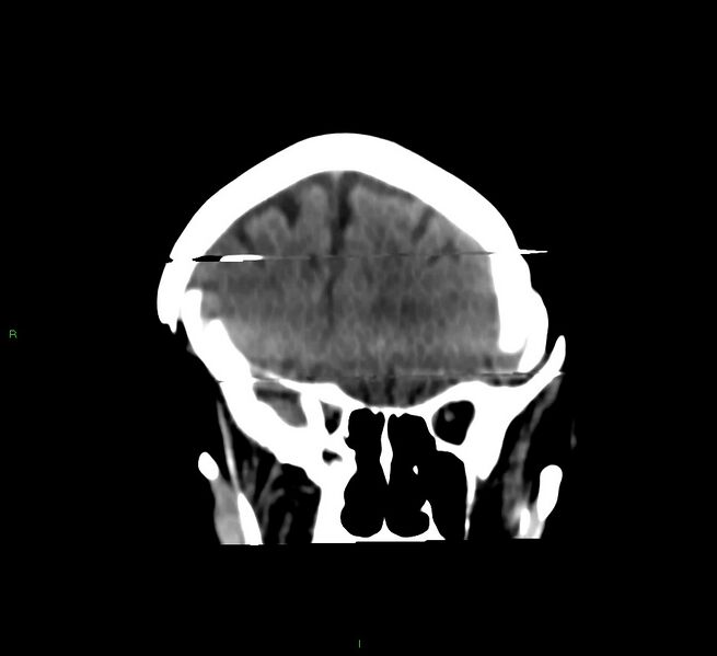 File:Cerebral amyloid angiopathy-associated lobar intracerebral hemorrhage (Radiopaedia 58377-65514 Coronal non-contrast 48).jpg