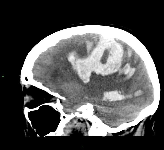 File:Cerebral amyloid angiopathy-associated lobar intracerebral hemorrhage (Radiopaedia 58379-65519 C 21).jpg