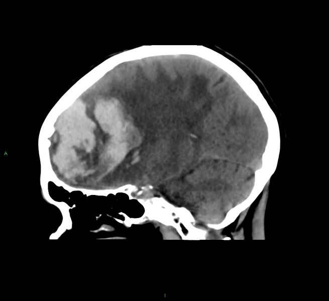 File:Cerebral amyloid angiopathy-associated lobar intracerebral hemorrhage (Radiopaedia 58561-65724 C 29).jpg