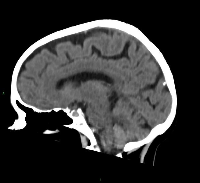 File:Cerebral amyloid angiopathy-associated lobar intracerebral hemorrhage (Radiopaedia 58757-65978 C 30).jpg