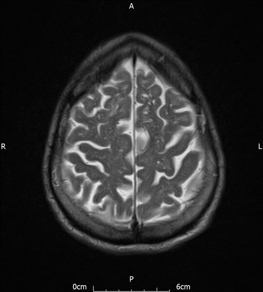 File:Cerebral amyloid angiopathy related inflammation (Radiopaedia 72772-83415 Axial T2 19).jpg