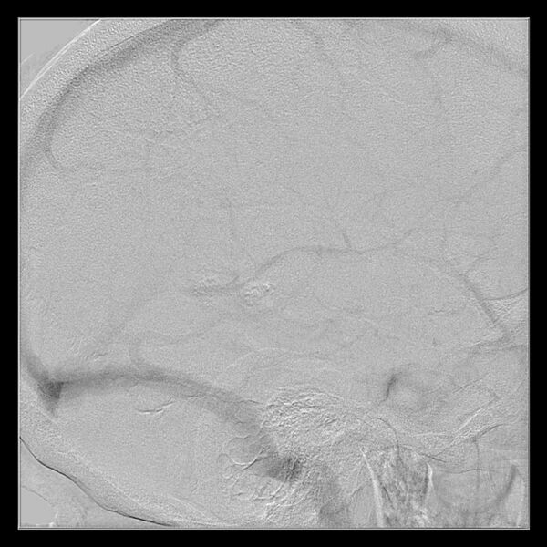 File:Cerebral aneurysm with rupture (Radiopaedia 29933-30458 LT ICA IC 51).jpg