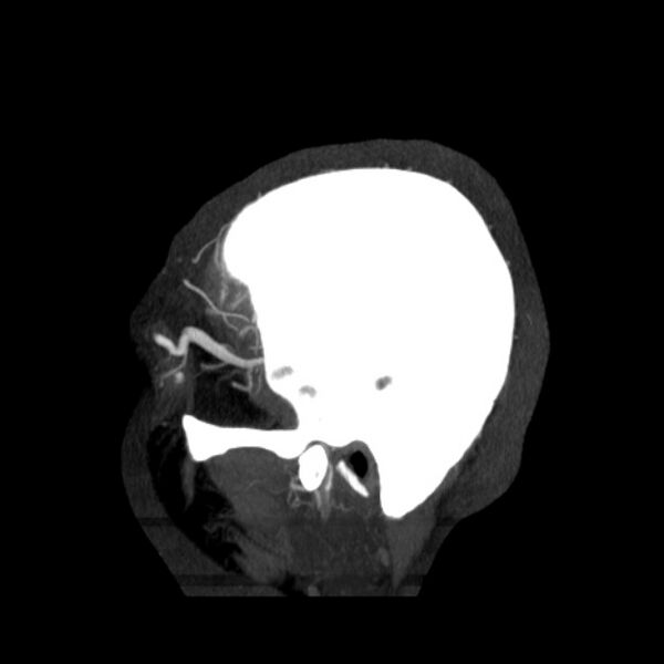 File:Cerebral arteriovenous malformation (Radiopaedia 43729-47189 D 48).jpg