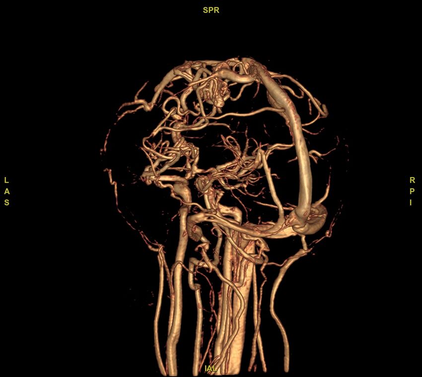Cerebral arteriovenous malformation (Radiopaedia 61964-70029 VRT 9).jpg