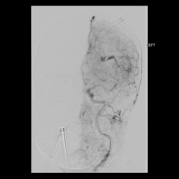 File:Cerebral arteriovenous malformation with lobar hemorrhage (Radiopaedia 44725-48513 LT CCA IC 15).png
