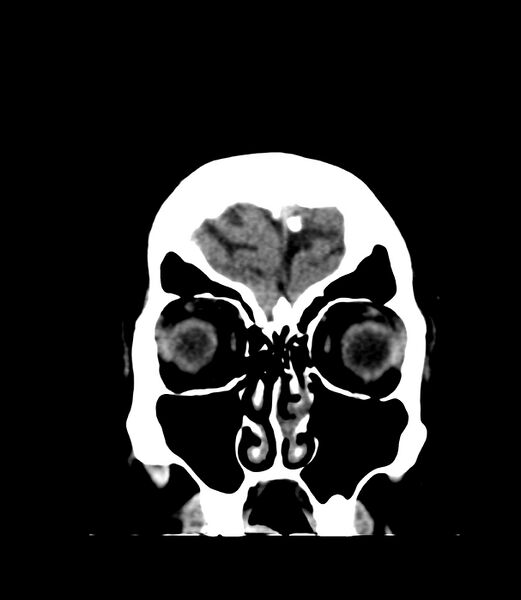 File:Cerebral dural venous sinus thrombosis (Radiopaedia 86514-102575 Coronal non-contrast 2).jpg