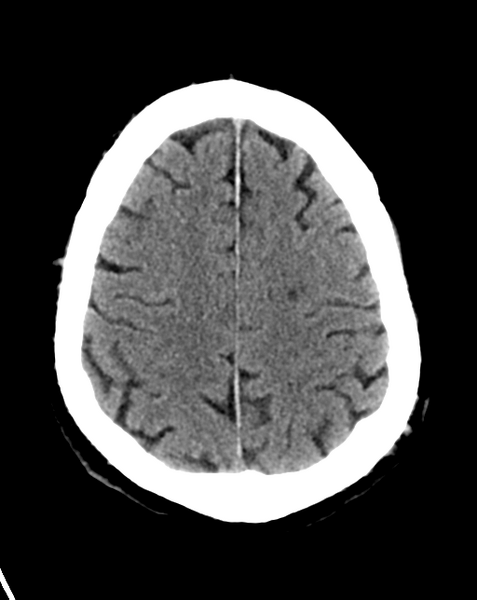File:Cerebral embolic infarcts (embolic shower) (Radiopaedia 57395-64341 Axial non-contrast 24).png