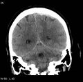 Cerebral hemorrhagic contusion with subdural and subarachnoid hemorrhage (Radiopaedia 10680-11146 Coronal non-contrast 13).jpg