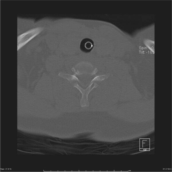 File:Cerebral hemorrhagic contusions and cervical spine fractures (Radiopaedia 32865-33841 C 27).jpg