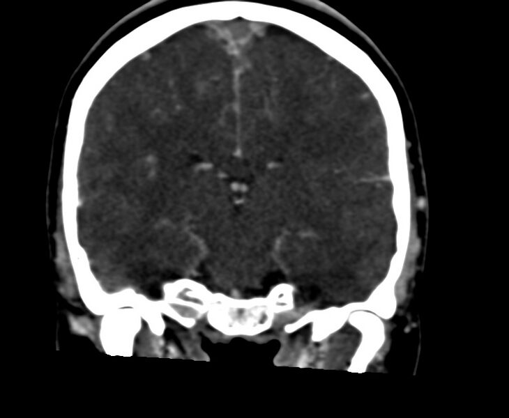 File:Cerebral venous sinus thrombosis (Radiopaedia 59224-66646 Coronal C+ delayed 42).jpg