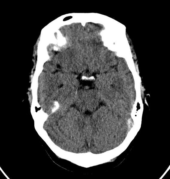 File:Cerebral venous thrombosis - CT only (Radiopaedia 41031-43778 Axial non-contrast 58).jpg