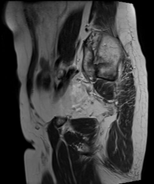 File:Cervical carcinoma (Radiopaedia 88312-104943 Sagittal T2 23).jpg