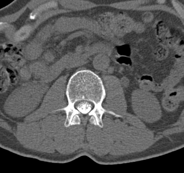 File:Cervical dural CSF leak on MRI and CT treated by blood patch (Radiopaedia 49748-54996 B 95).png