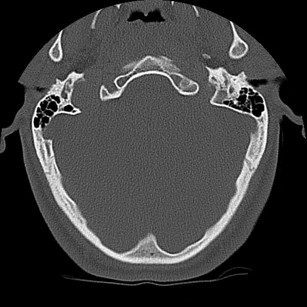 File:Cervical flexion teardrop fracture with cord hemorrhage (Radiopaedia 32497-33454 Axial bone window 3).jpg