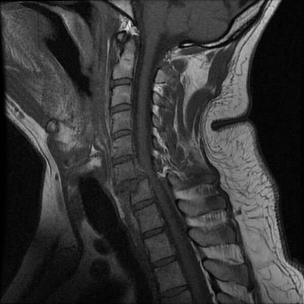 File:Cervical fracture and dislocation with locked facet (Radiopaedia 31837-32781 Sagittal T1 9).jpg