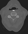 Cervical spine ACDF loosening (Radiopaedia 48998-54071 Axial bone window 27).png