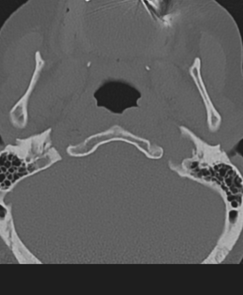 File:Cervical spine ACDF loosening (Radiopaedia 48998-54071 Axial bone window 7).png