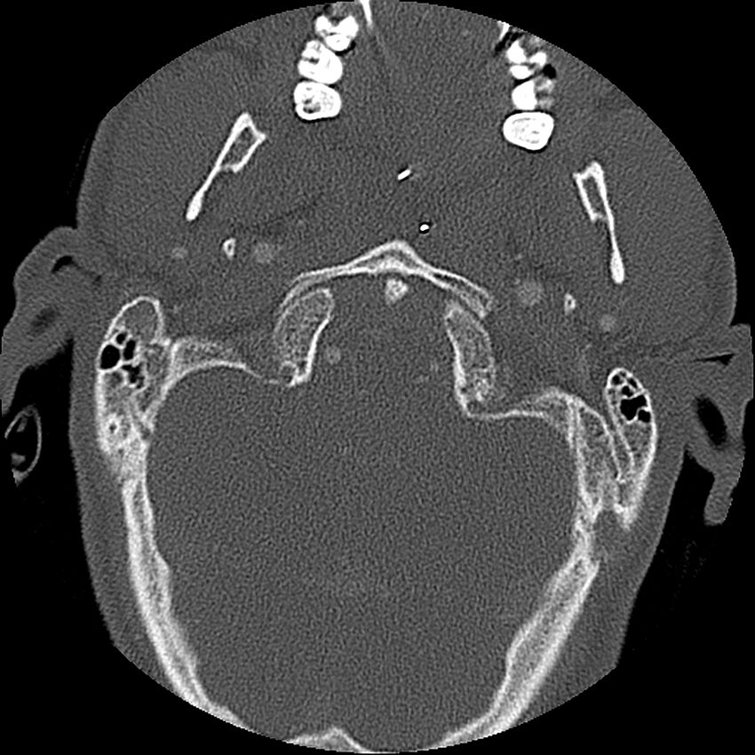 Cervical spine fractures with vertebral artery dissection (Radiopaedia 32135-33078 Axial bone window 73).jpg