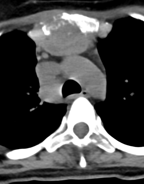 File:Cervical tuberculous spondylitis (Radiopaedia 39149-41365 Axial non-contrast 61).png