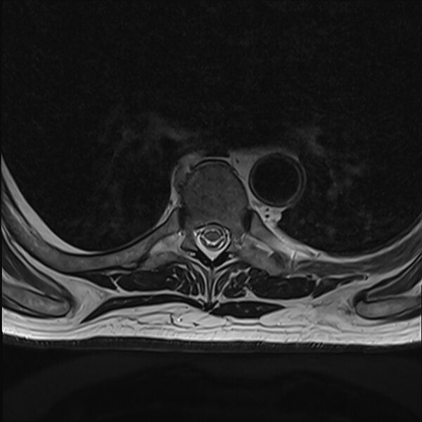File:Cervical tumor-like myelopathy due to Type V dAVF (Radiopaedia 82461-96604 D 23).jpg