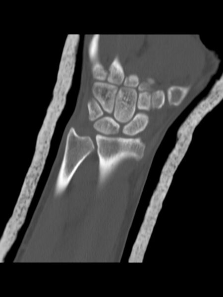 File:Chauffeur's (Hutchinson) fracture (Radiopaedia 58043-65079 Coronal bone window 6).jpg