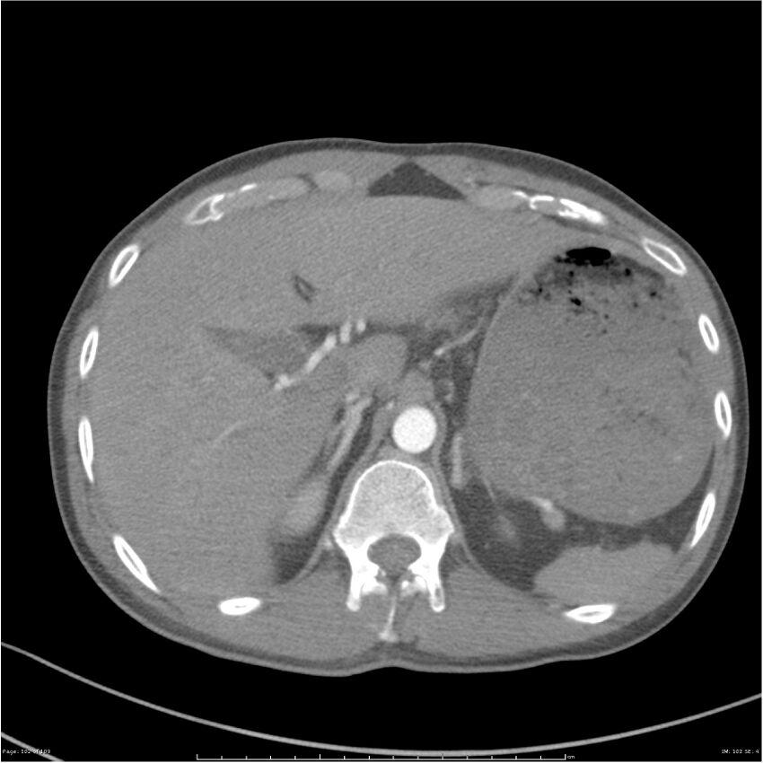 Chest and abdomen multi-trauma (Radiopaedia 26294-26425 A 102).jpg